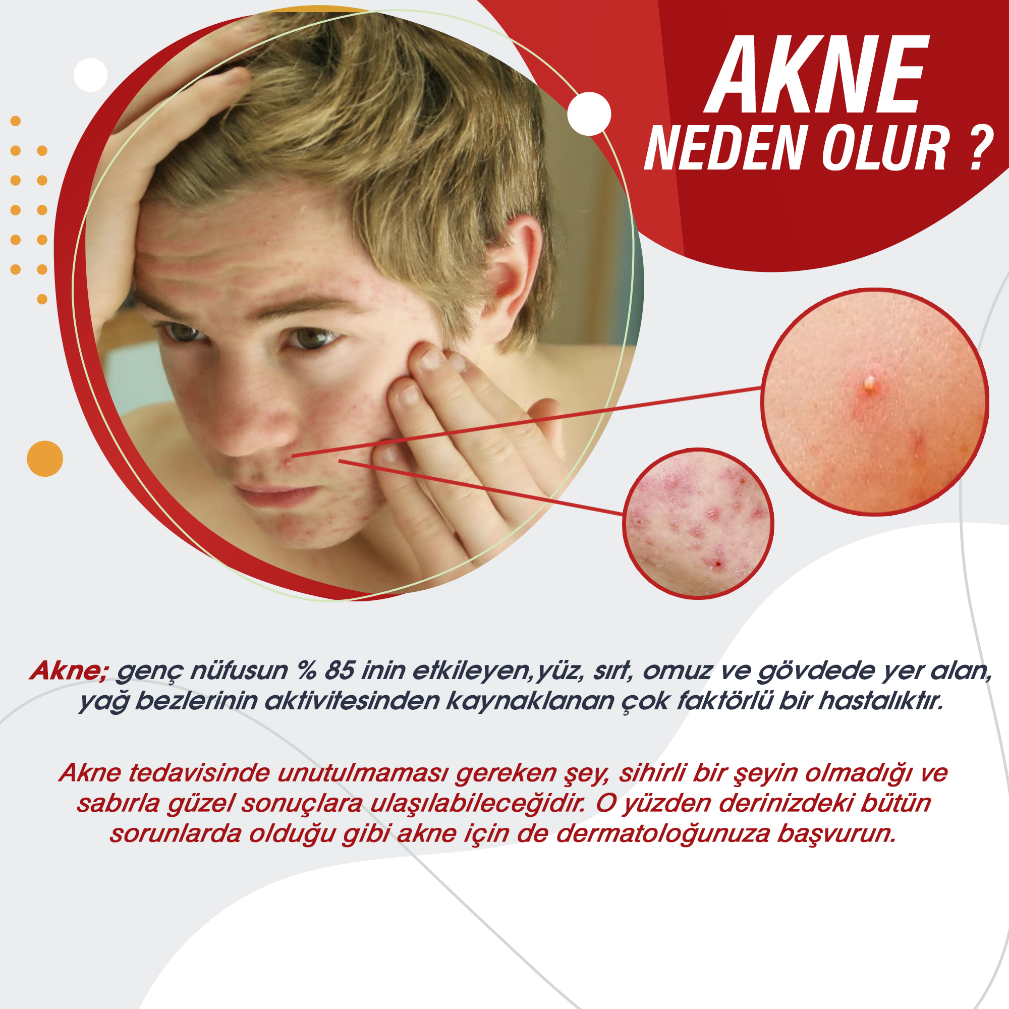 AKNE NEDİR?