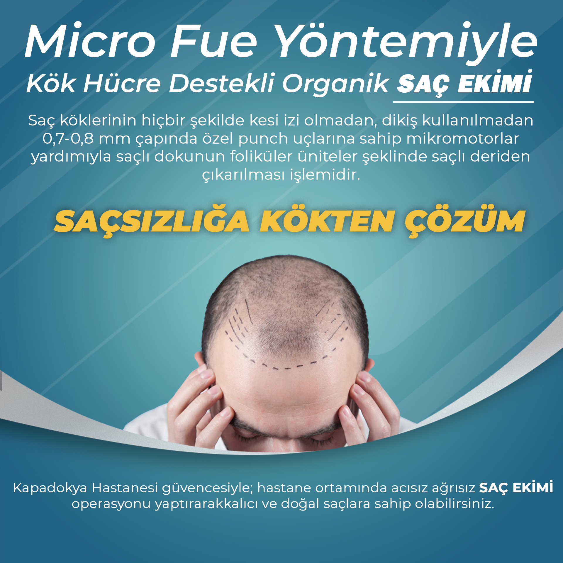 Micro Fue Yöntemiyle Kök Hücre Destekli Organik Saç ekimi