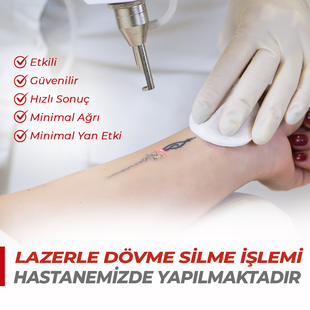 Lazerle dövme silme işlemi nasıl uygulanır?