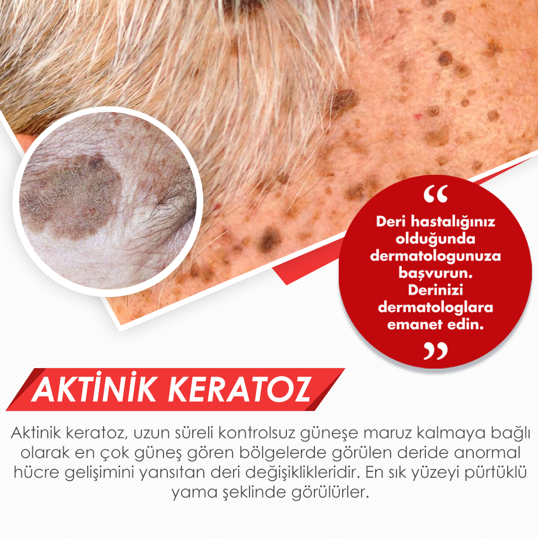 AKTİNİK KERATOZ