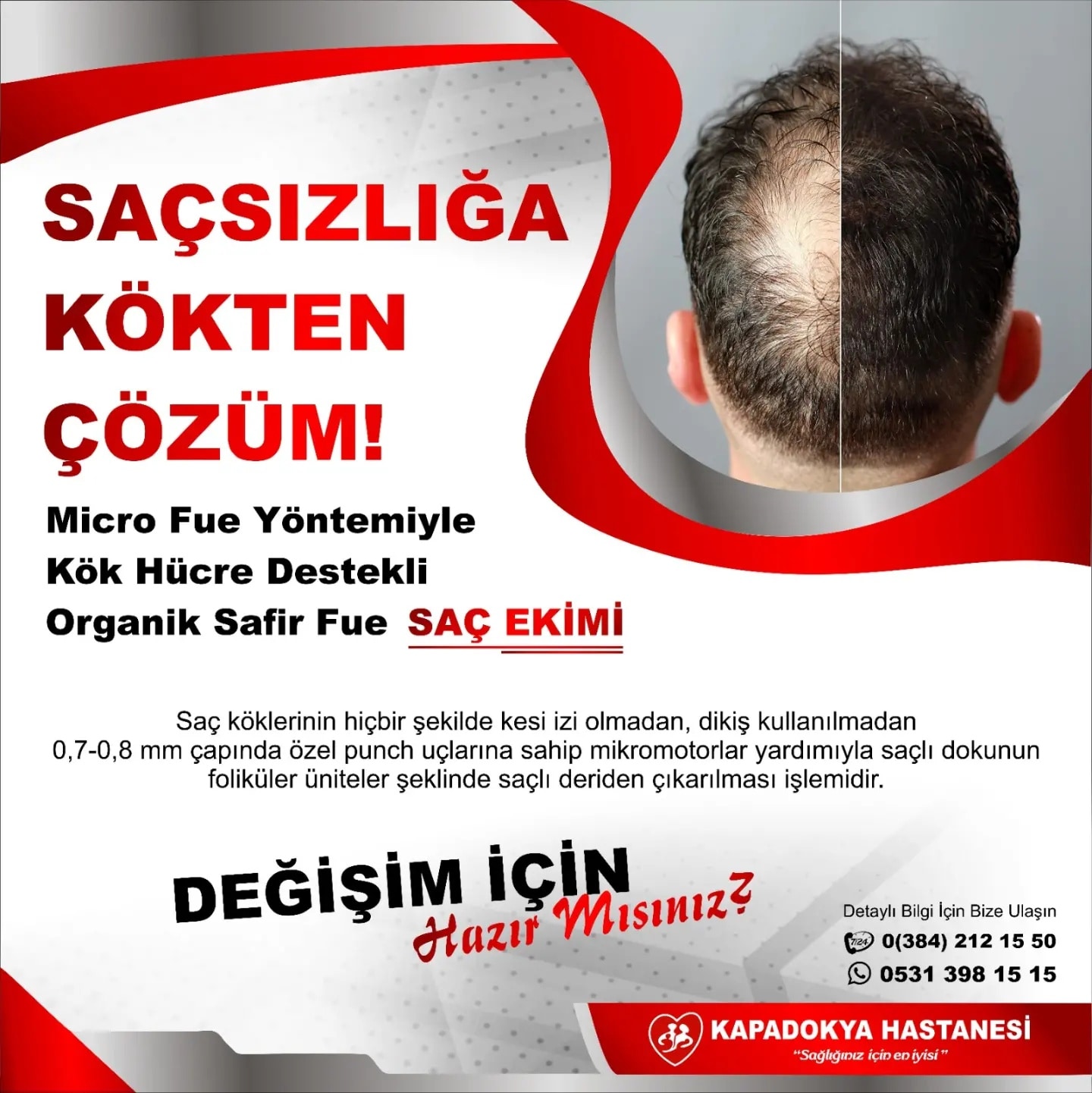 SAÇSIZLIĞA KÖKTEN ÇÖZÜM